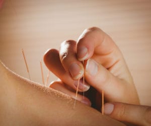 How Acupuncture Can Aid in Your Recovery