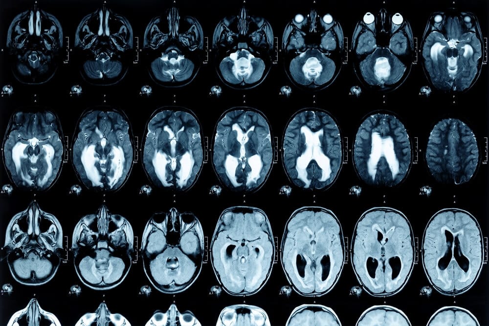long-term brain damage from drug overdose understanding the effects