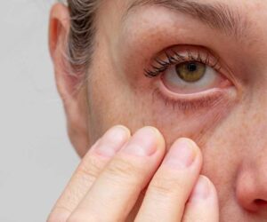 Why Does Alcohol Cause Face Puffiness?