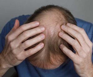 The Connection Between Hair Loss and Alcoholism